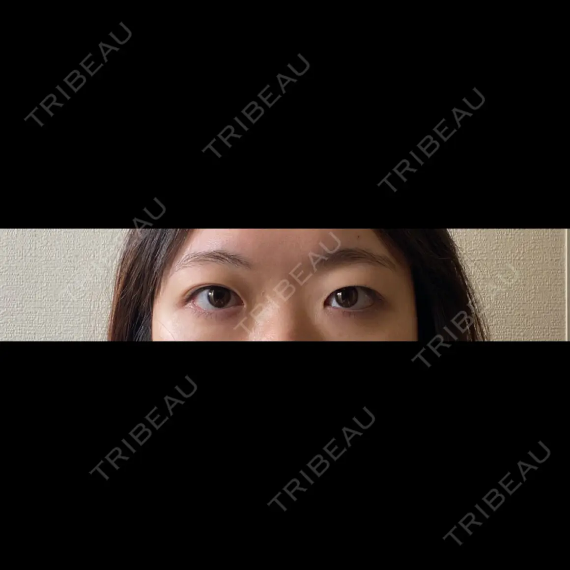 二重埋没 / 目頭切開 / 糸リフト / 脂肪吸引（顔） HAAB×DREAM BEAUTY CLINIC 東京本院 AFTER