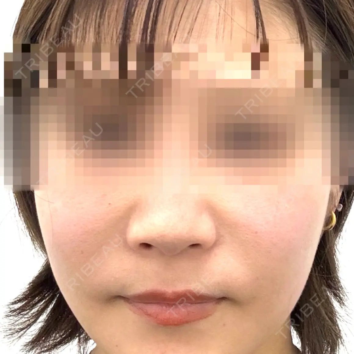 鼻中隔延長（非切開） YBC横浜美容外科 池袋院 AFTER