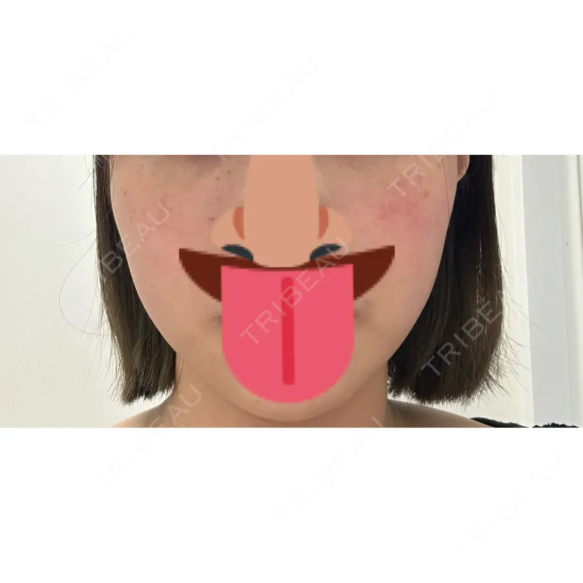 ボトックス（エラ・小顔） 共立美容外科 渋谷院 AFTER