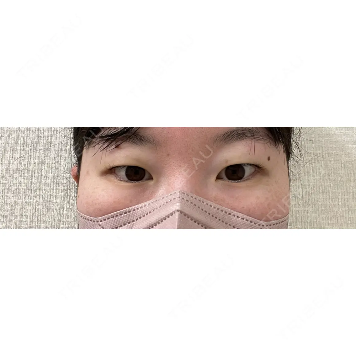 二重埋没 / 上まぶたの脂肪取り 湘南美容クリニック 西葛西院 AFTER