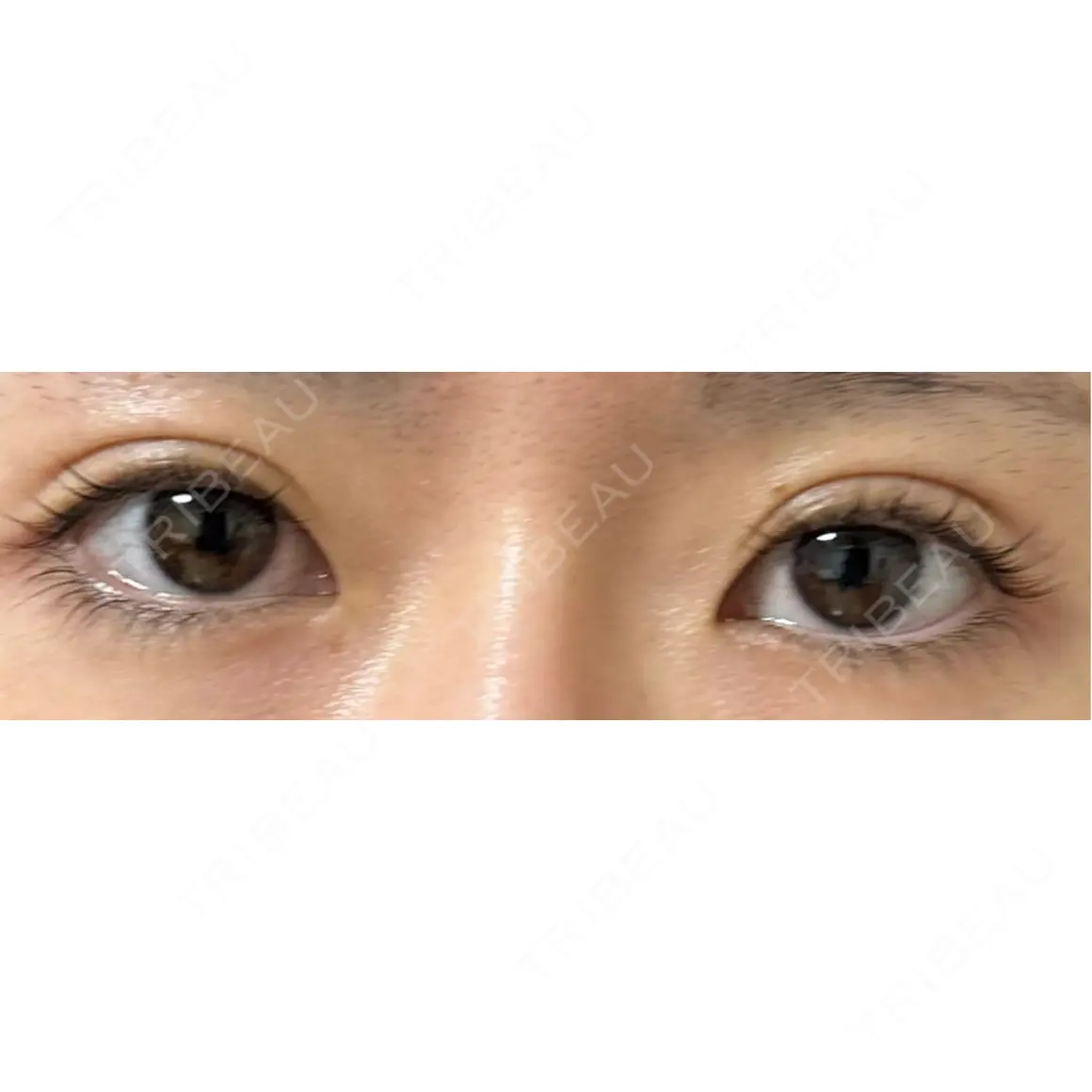 目頭切開 9BeautyClinic AFTER