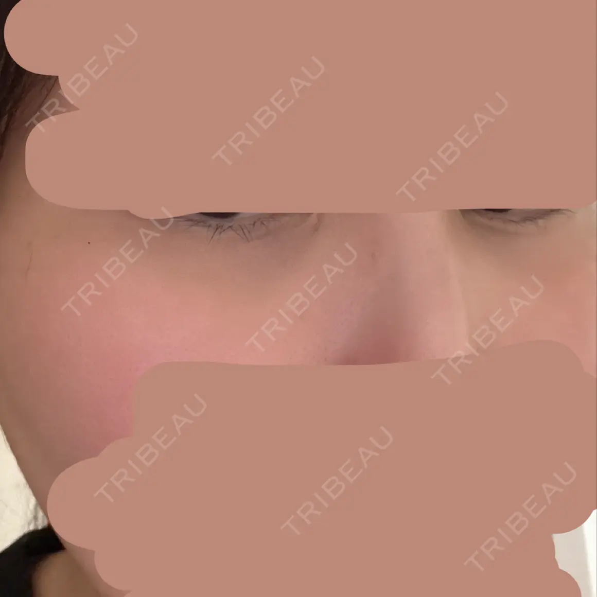 ヒアルロン酸注入（涙袋） / ヒアルロン酸注入（唇） PRO CLINIC プロクリニック 銀座院 AFTER