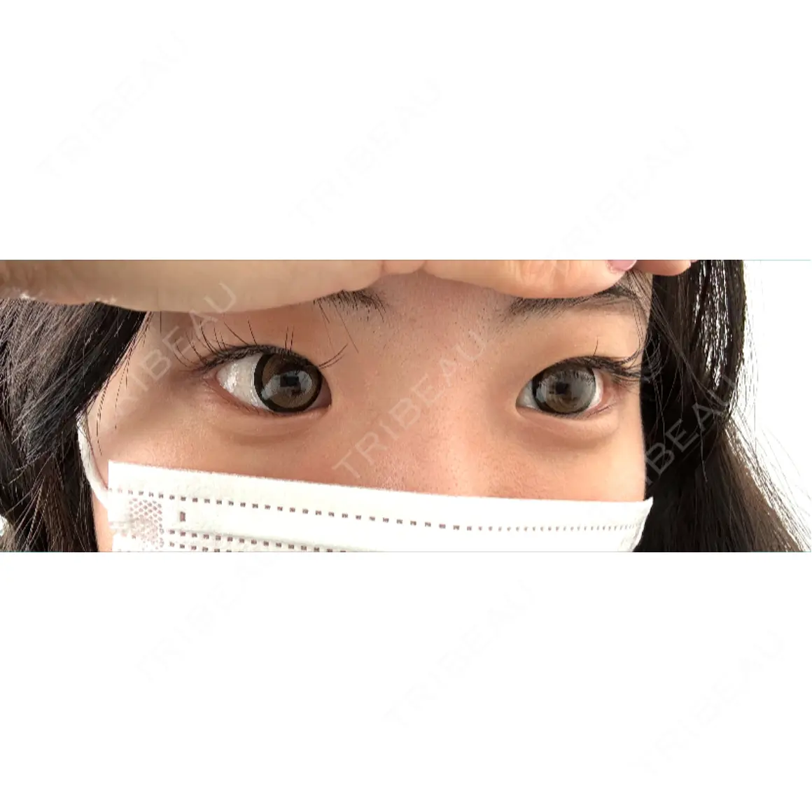 二重埋没 / 目頭切開 MIL CLINIC OSAKA AFTER