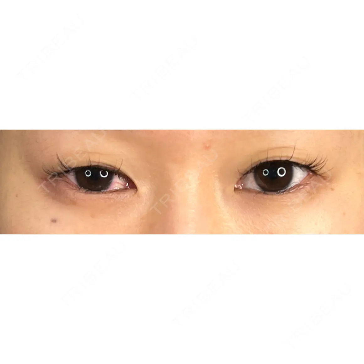二重埋没 / 目尻切開 / その他（目元） 藤・ナチュレ美容クリニック 銀座院 AFTER