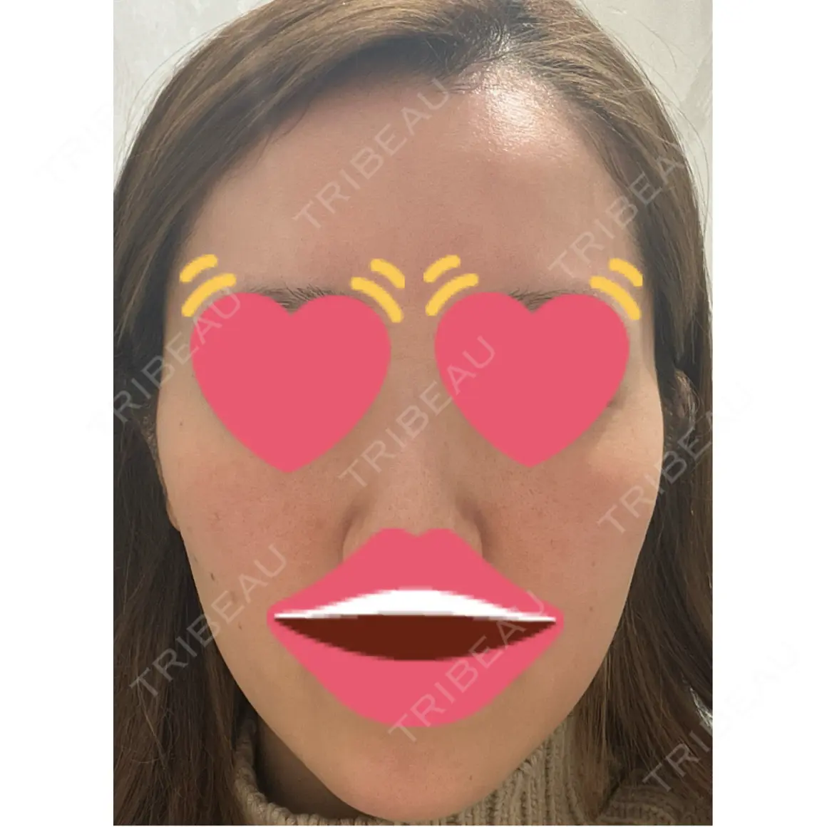 美肌レーザー / 美白レーザー / ピコレーザートーニング（美白・肝斑） 銀座みゆき通り美容外科 大阪梅田院 AFTER