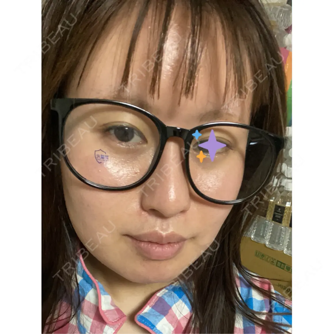 ピーリング（ニキビ・毛穴） ルラ美容クリニック 新潟院 AFTER