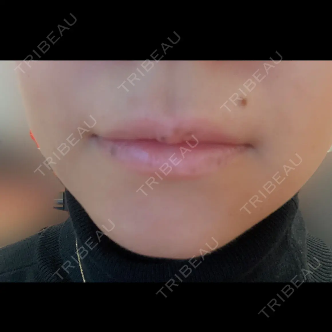 ボトックス（口角） ブルームクリニック（BLOOM CLINIC） AFTER