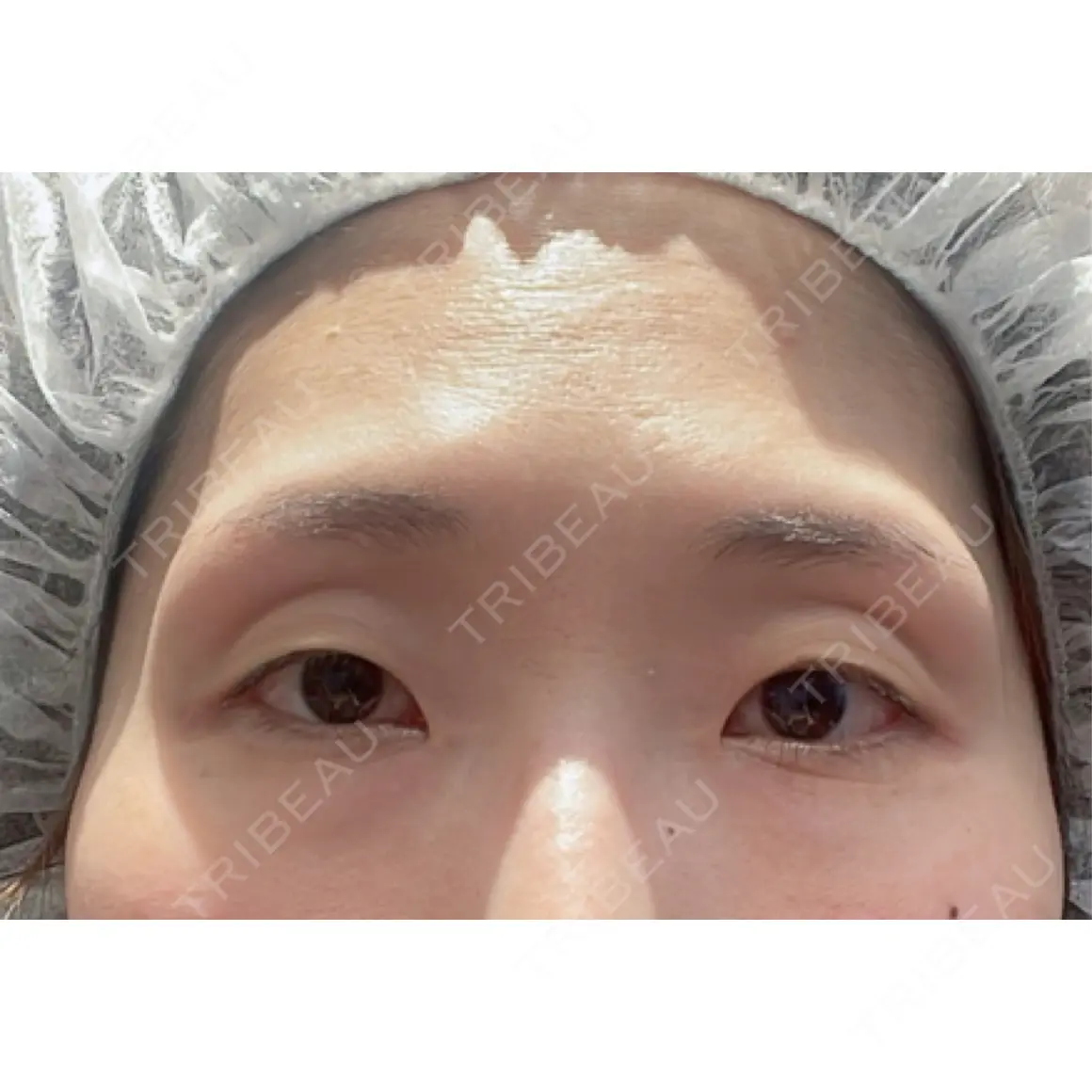 二重切開 / 眼瞼下垂（切開） / 上まぶたの脂肪取り オーキッド美容クリニック東京御徒町 AFTER