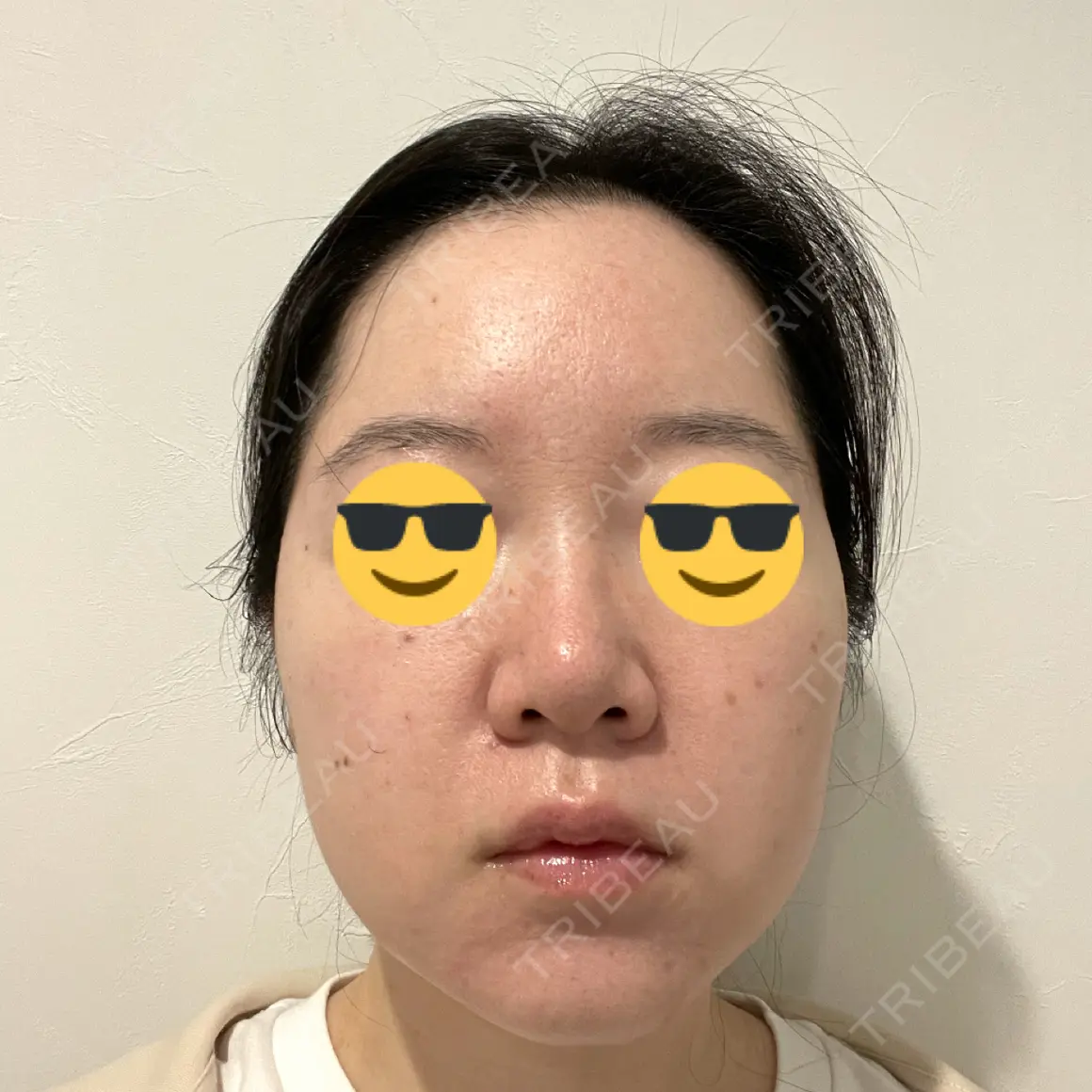 脂肪吸引（顔） Mods Clinic（モッズクリニック） 大阪院 AFTER