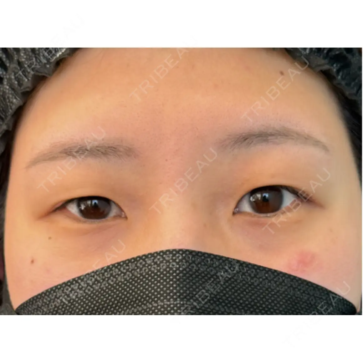 二重埋没 湘南美容クリニック 千葉センシティ院 AFTER