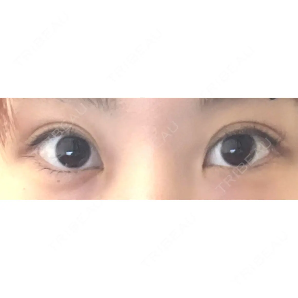 目頭切開 9BeautyClinic AFTER