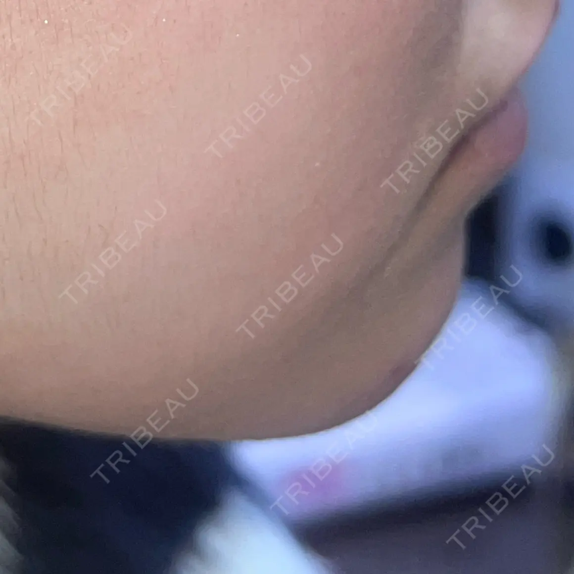 ボトックス（あご） / ヒアルロン酸注入（あご） / ボトックス（エラ・小顔） ルラ美容クリニック 名古屋本院 AFTER