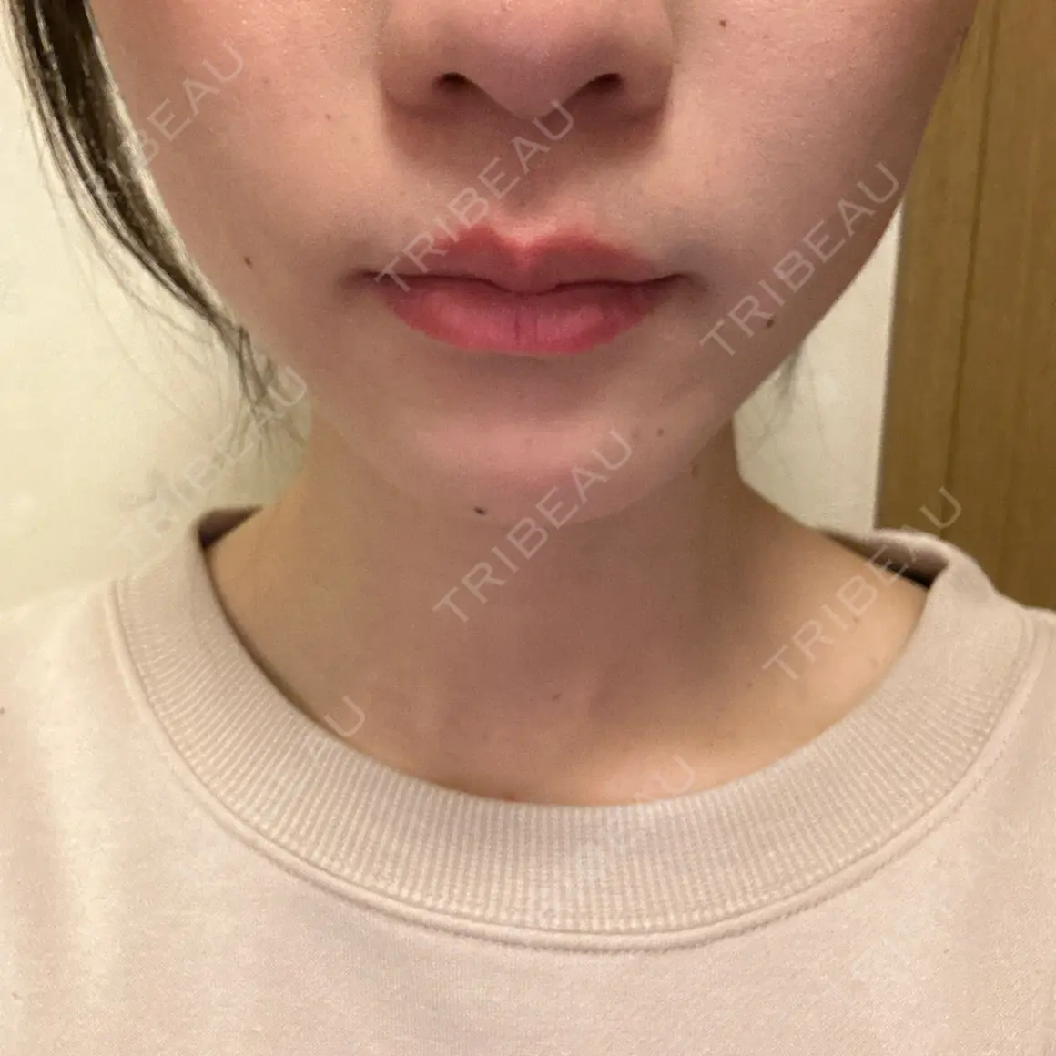 小鼻縮小（非切開） YBC横浜美容外科 池袋院 AFTER