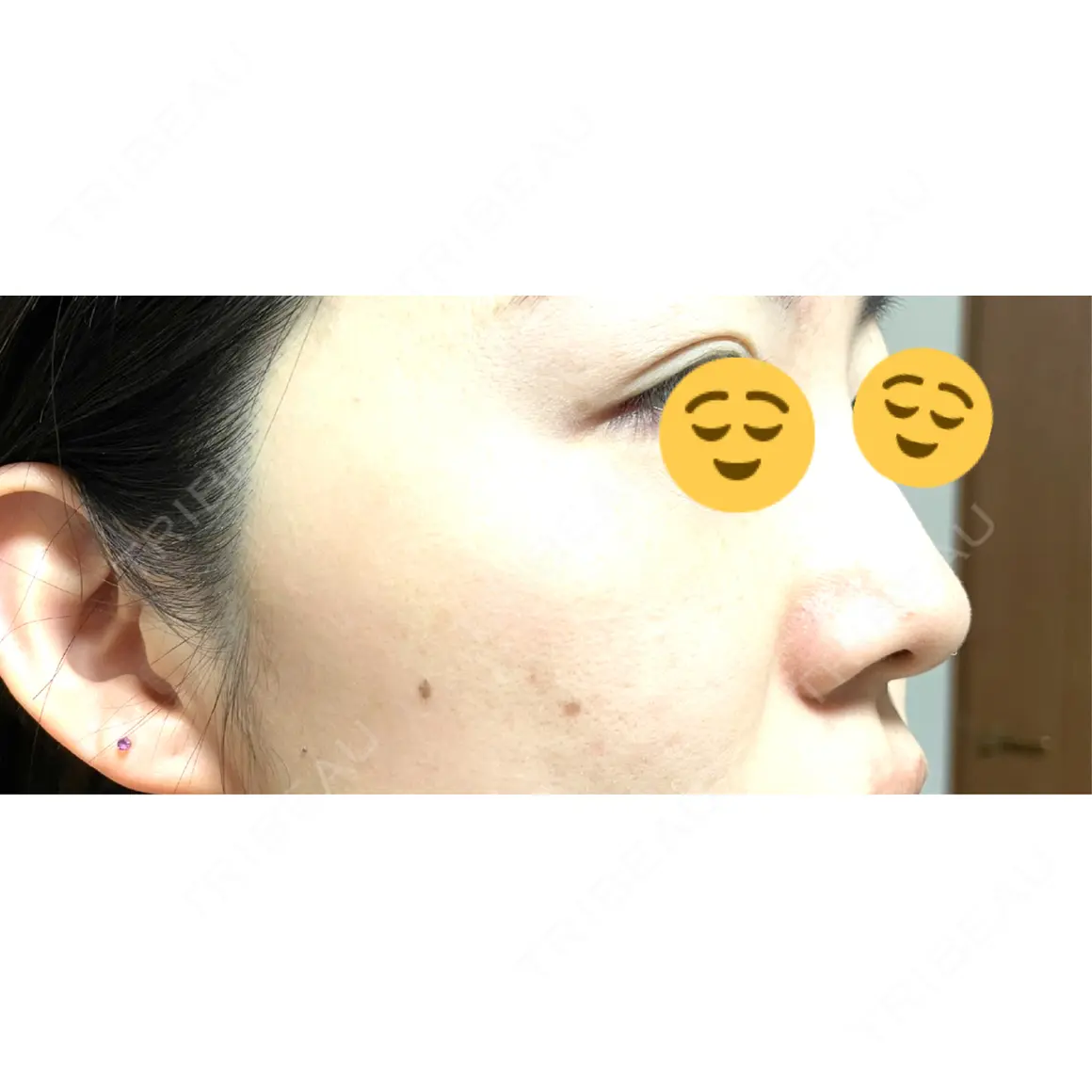 プラズマ治療 / ルメッカ GLAMRULE CLINIC (グラムルール クリニック) 銀座院 AFTER