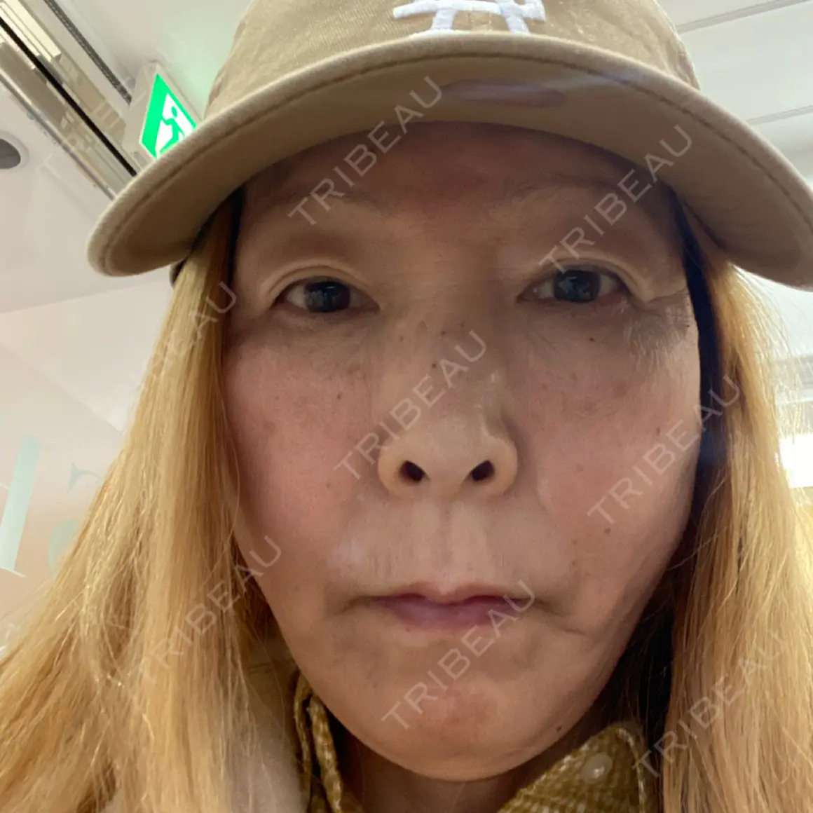 肌ヒアルロン酸注入（たるみ・シワ改善） 湘南美容クリニック 西葛西院 AFTER