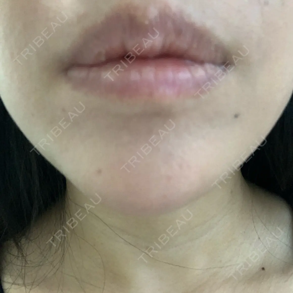 ヒアルロン酸注入（唇） PRO CLINIC プロクリニック 銀座院 AFTER