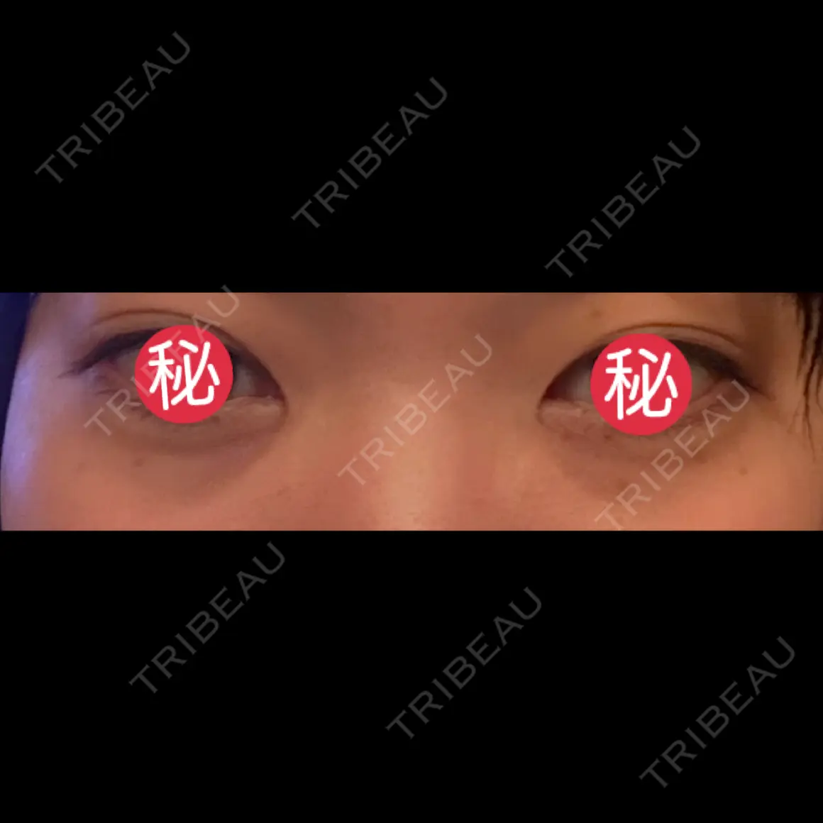 クマ治療 EMMO FACE CLINIC 東京三田院 AFTER