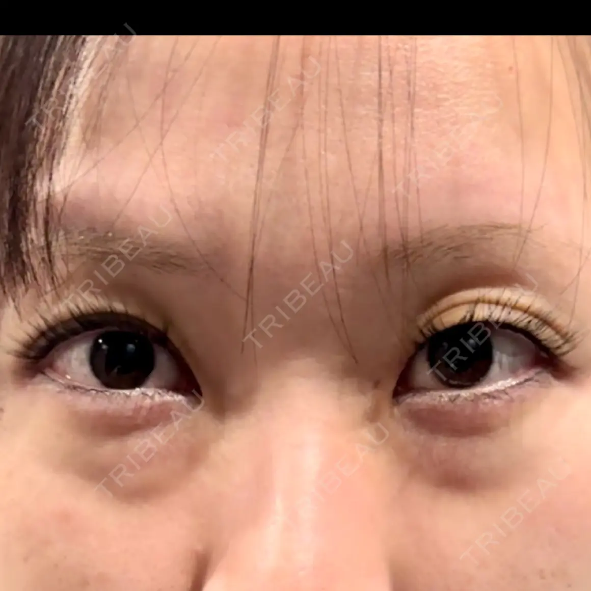 クマ治療 ARIEL.BUST.CLINIC AFTER