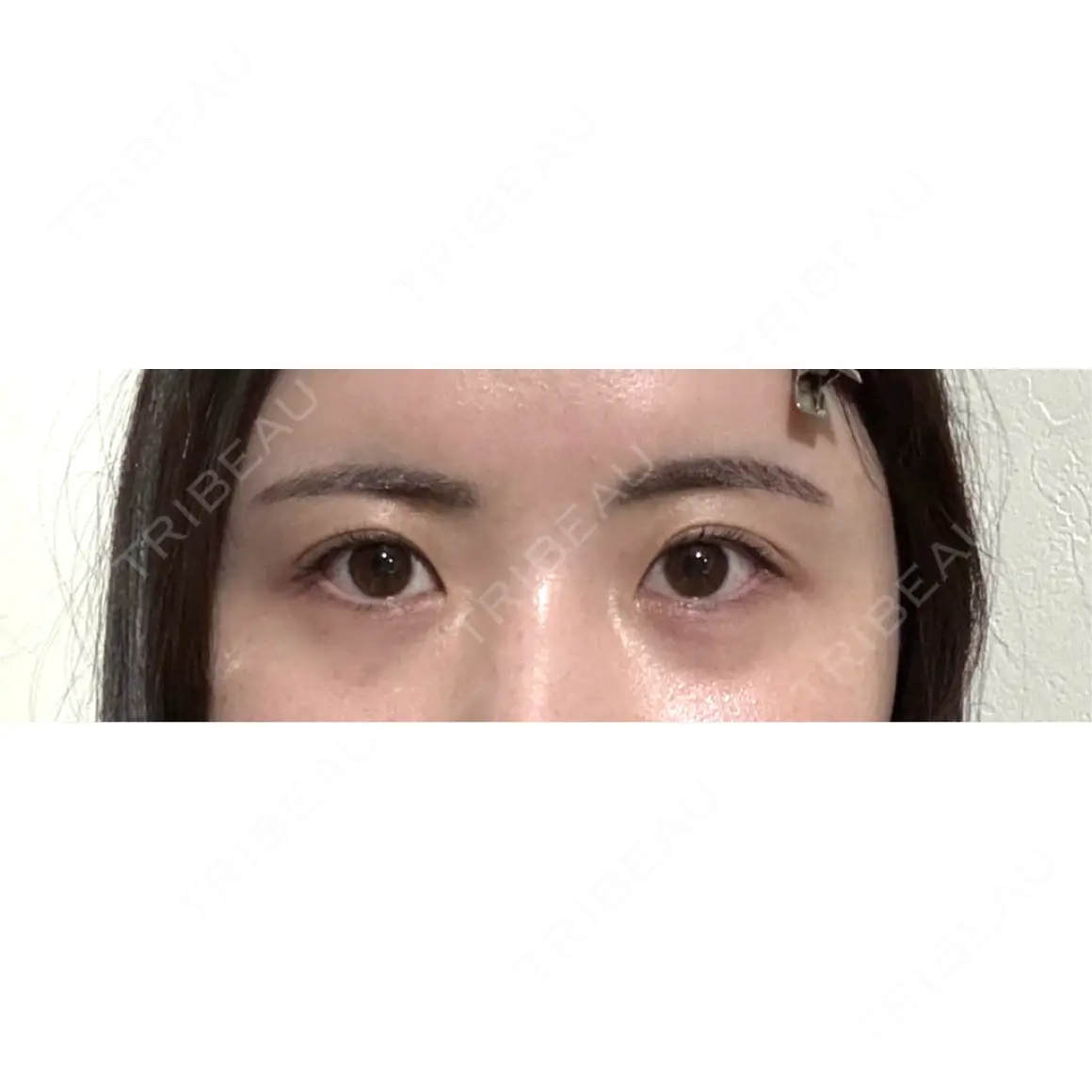 二重埋没 湘南美容クリニック 池袋東口院 AFTER