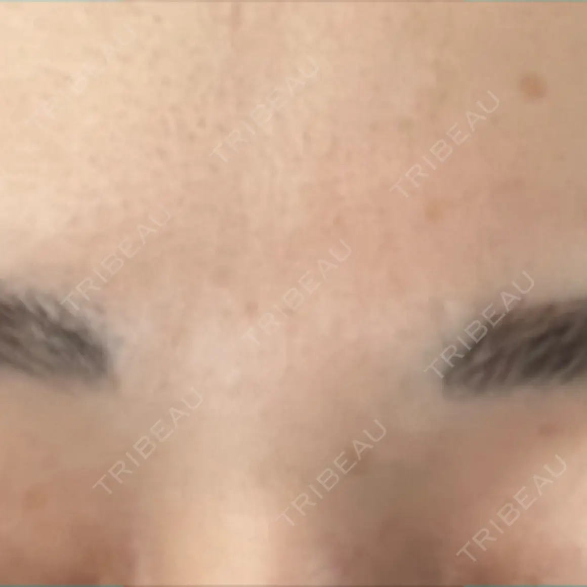 ボトックス（眉間） Leap beauty clinic AFTER