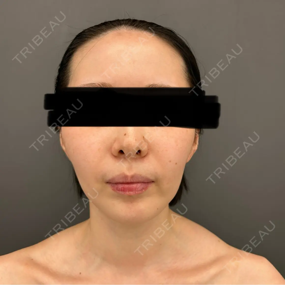 脂肪吸引（顔） / 脂肪吸引（脚） / 脂肪注入（肌） / 脂肪注入（額） / ジョールファット除去 / 脂肪注入（輪郭） Casa de GRACIA GINZA 【カーサデグラシアギンザ】 AFTER