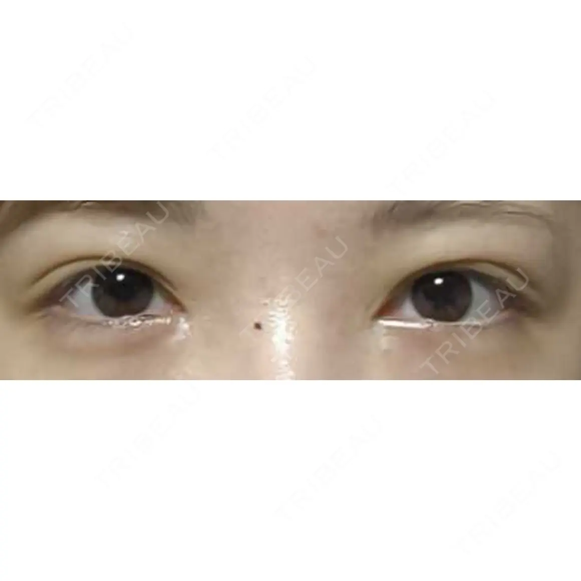 眼瞼下垂（切開） / ボトックス（額） Otus Clinic 【オータスクリニック】 AFTER