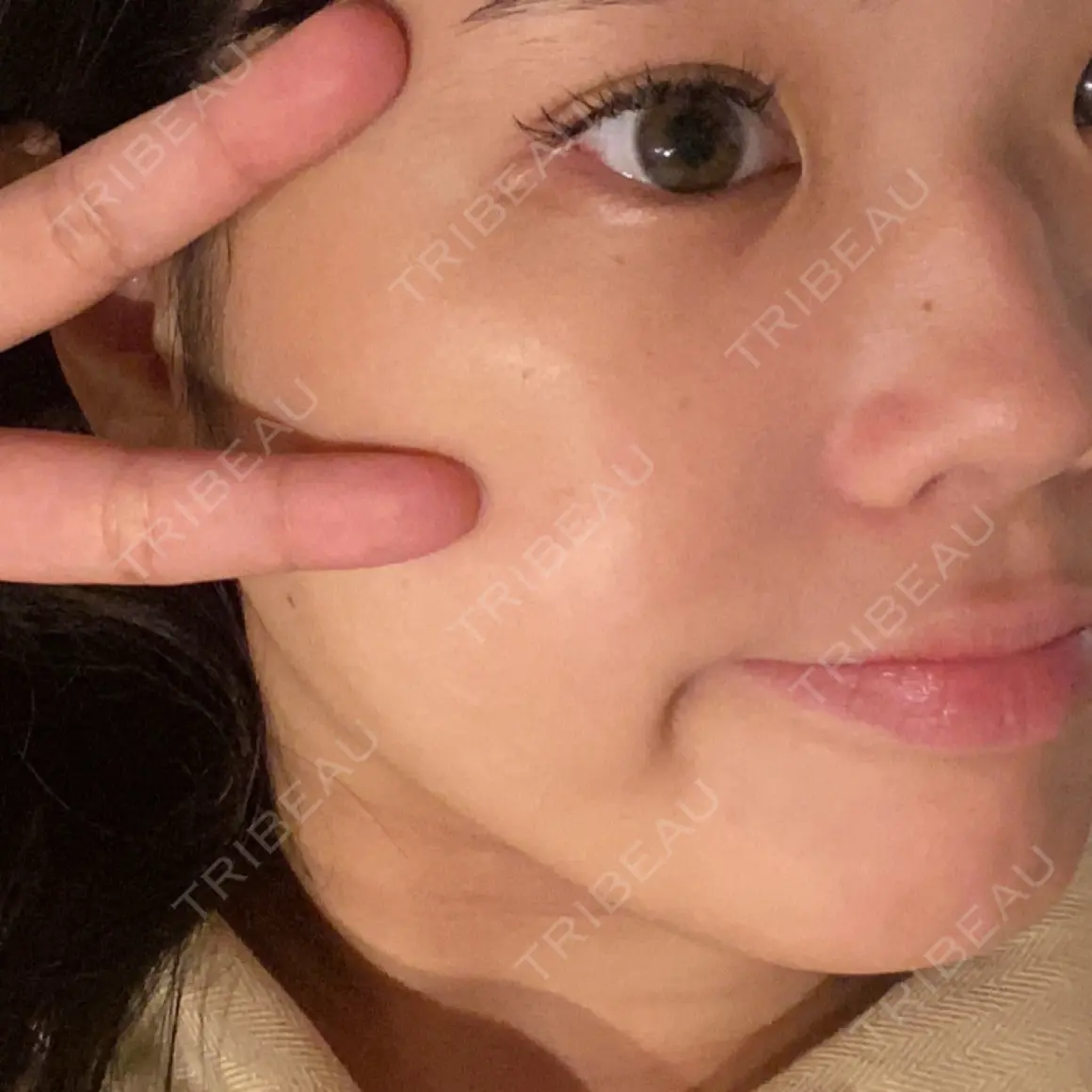 ボトックス（エラ・小顔） 共立美容外科 新宿本院 AFTER