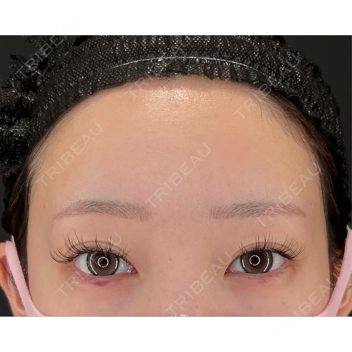 脂肪注入（額） HAAB×DREAM BEAUTY CLINIC 大阪梅田院 AFTER