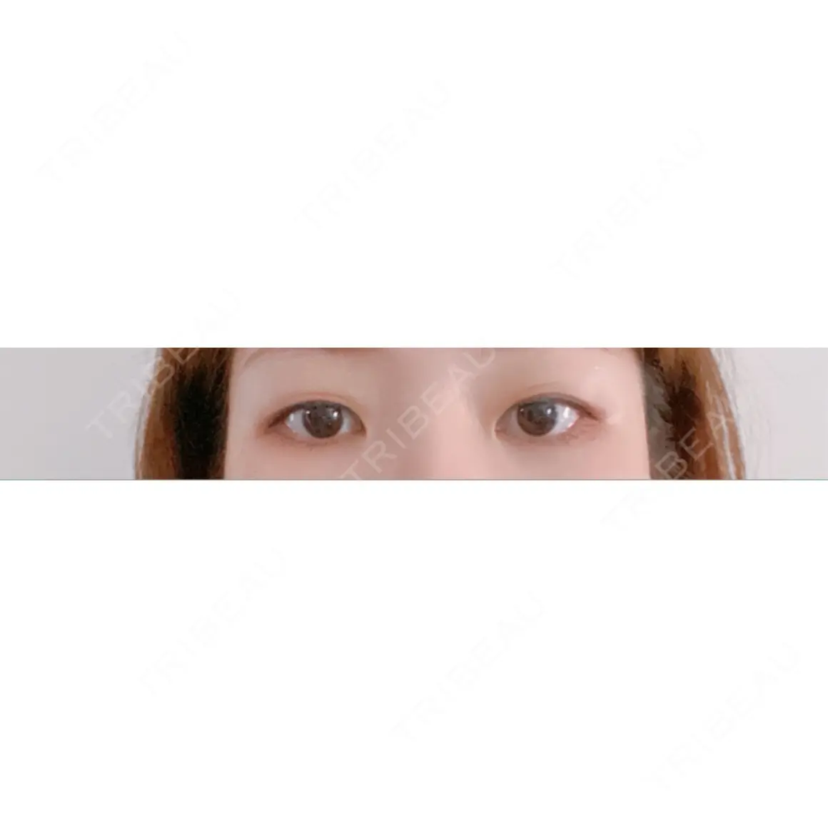 二重埋没 ブルームクリニック（BLOOM CLINIC） AFTER