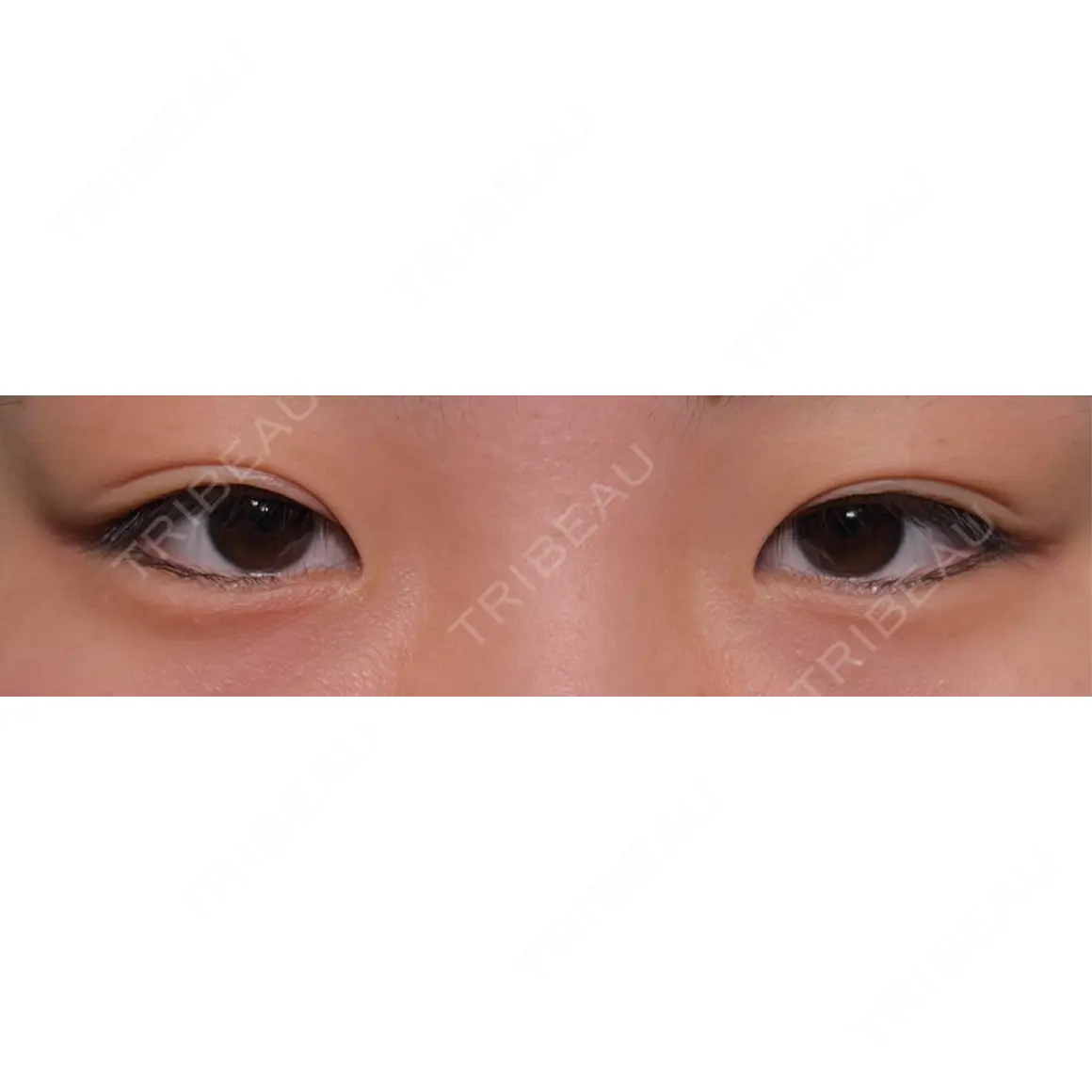 目頭切開 HAAB×DREAM BEAUTY CLINIC 大阪梅田院 AFTER