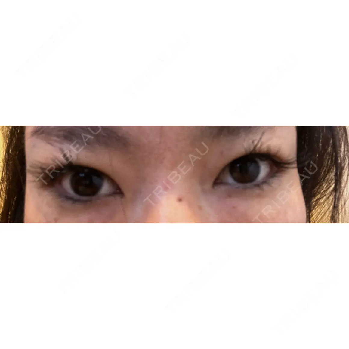 二重埋没 / 目尻切開 / 下まぶたの脂肪取り / タレ目形成・グラマラスライン（切開） / 目尻靭帯移動 エターナル美容クリニック AFTER