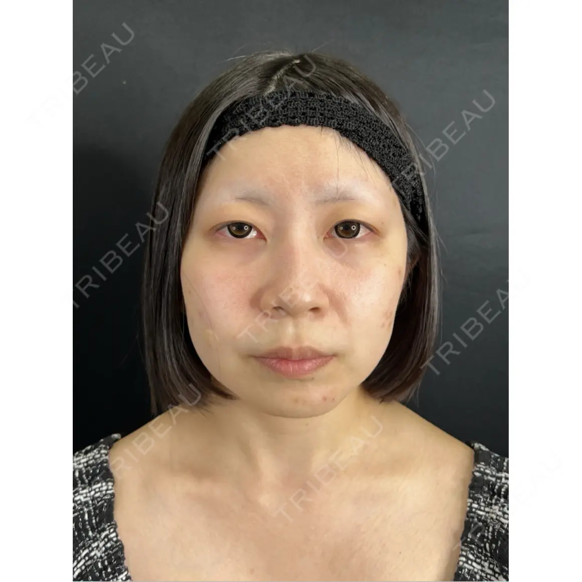 二重埋没 / 上まぶたの脂肪取り 藤・ナチュレ美容クリニック 銀座院 AFTER