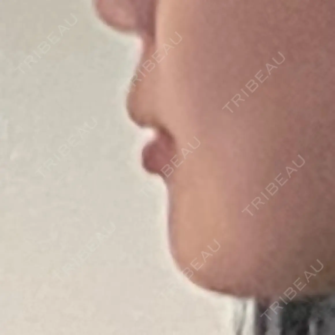 ボトックス（あご） / ヒアルロン酸注入（あご） ルラ美容クリニック 名古屋本院 AFTER