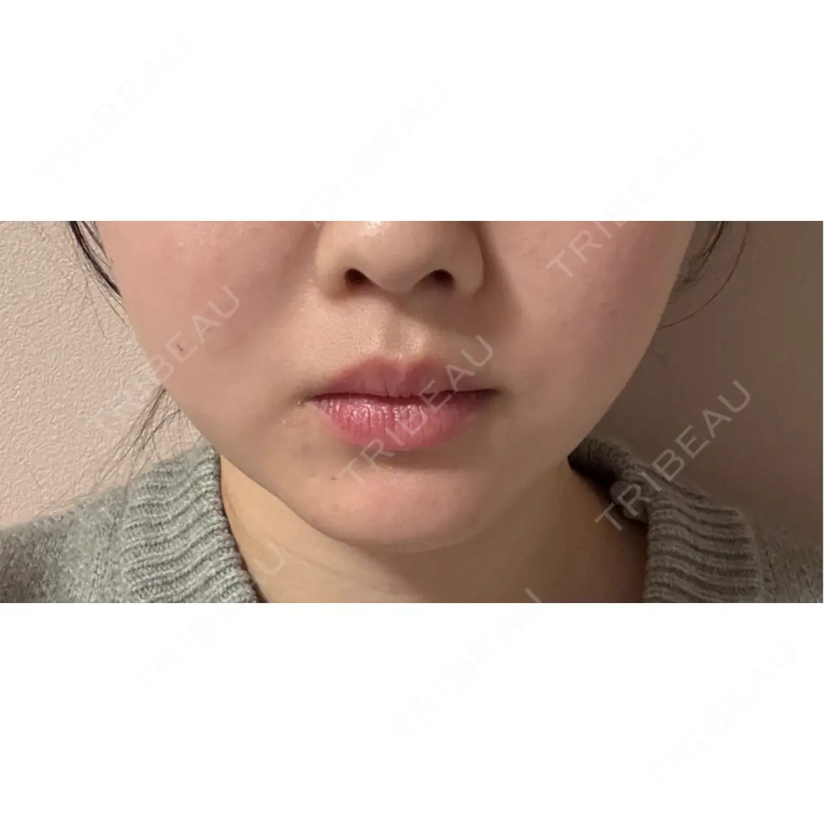 ボトックス（エラ・小顔） TCB東京中央美容外科 町田院 AFTER