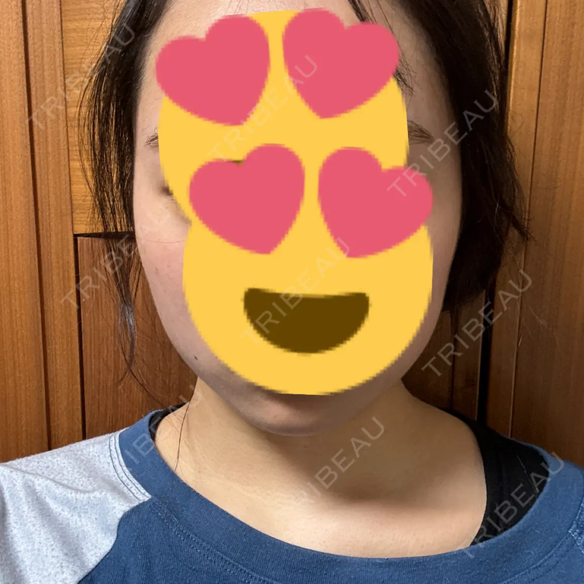 ボトックス（額） TCB東京中央美容外科 草津院 AFTER