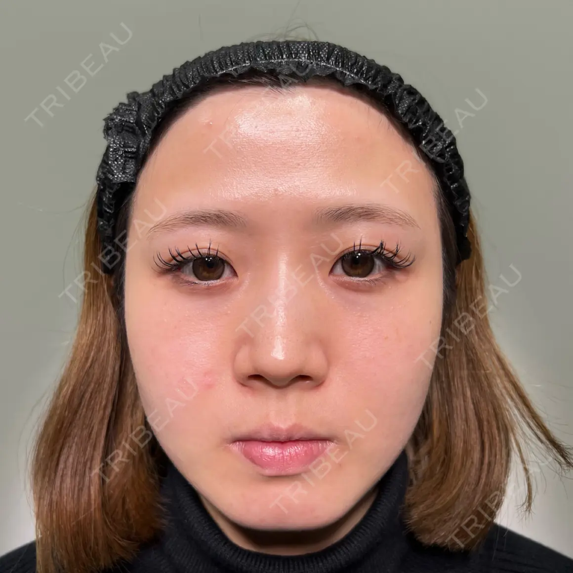 二重埋没 / 目頭切開 / 糸リフト / ヒアルロン酸注入（涙袋） / ヒアルロン酸注入（鼻） / ヒアルロン酸注入（あご） / ヒアルロン酸注入（唇） HAAB×DREAM BEAUTY CLINIC 大阪梅田院 AFTER