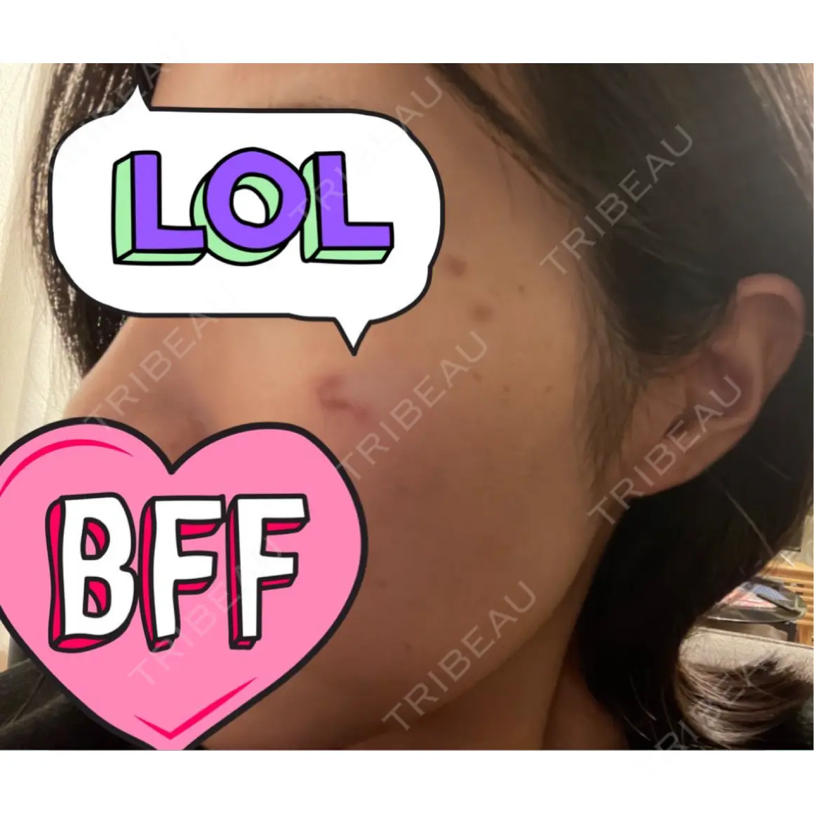 シミ取りレーザー CHARIS BEAUTY CLINIC AFTER