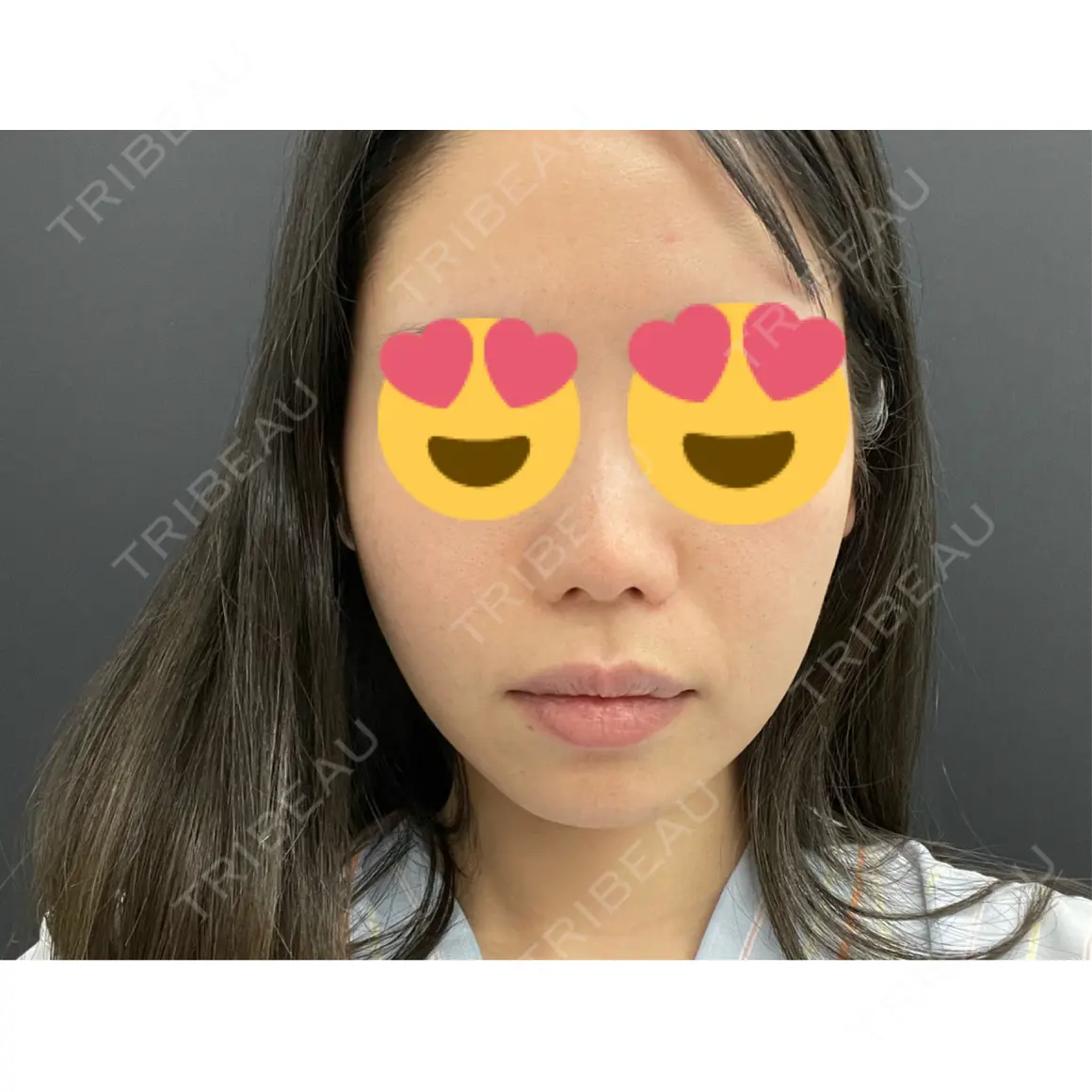 鼻尖形成（切開） / 糸リフト / 脂肪吸引（顔） / 軟骨移植 / その他（鼻） MIL CLINIC OSAKA AFTER