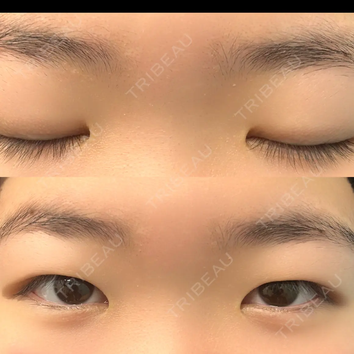 二重埋没 湘南美容クリニック 千葉センシティ院 AFTER