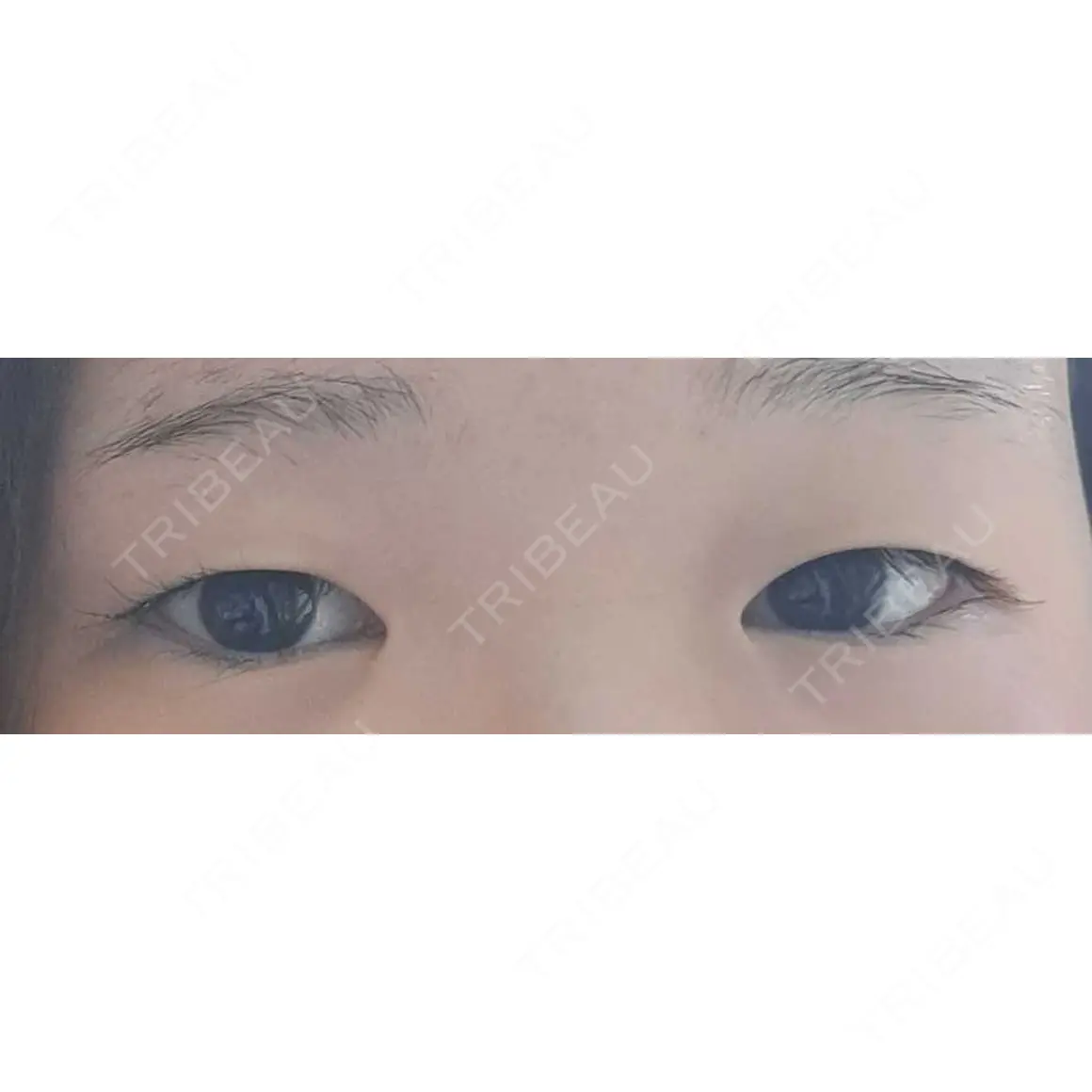 二重埋没 湘南美容クリニック 千葉センシティ院 AFTER
