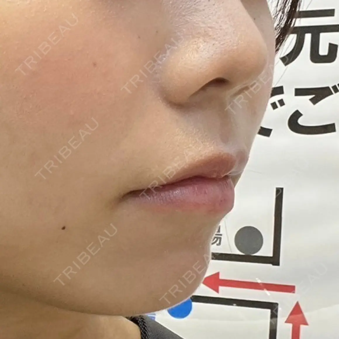 人中短縮 ルラ美容クリニック 東京駅前院 AFTER