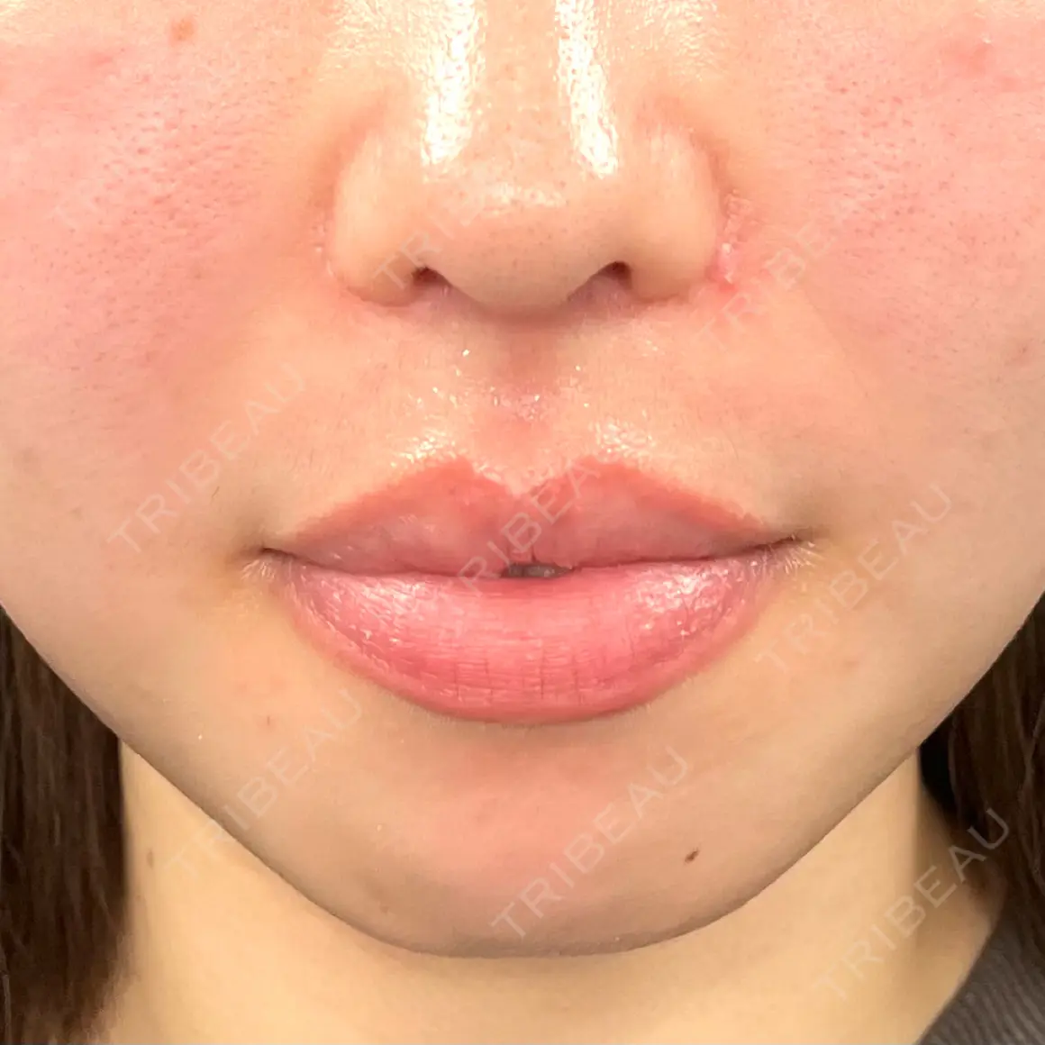 ボトックス（あご） / その他（口元） THE FIRST CLINIC 町田院 AFTER