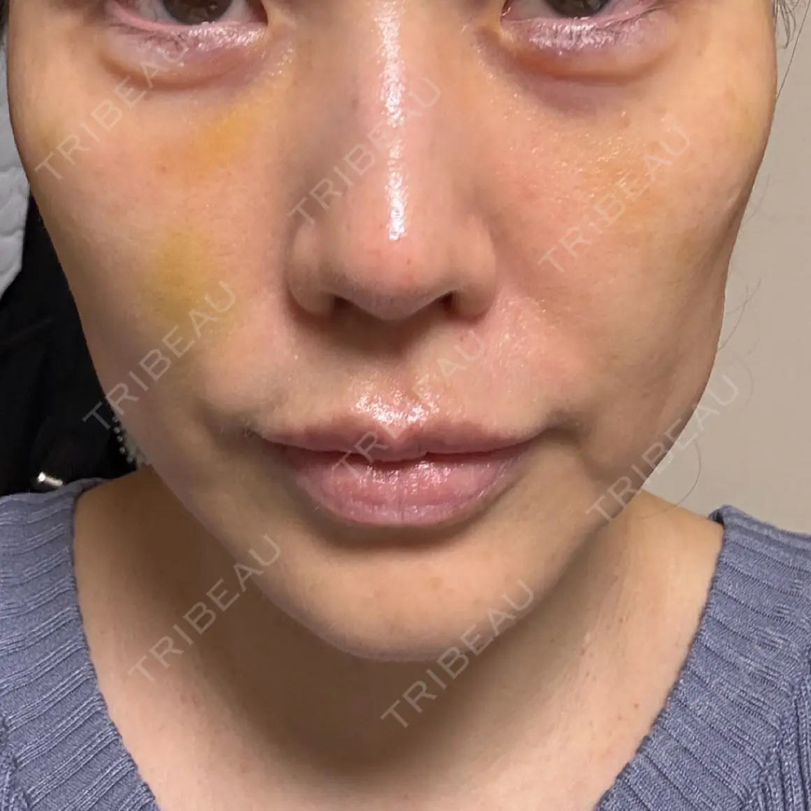 糸リフト X CLINIC 銀座院 AFTER