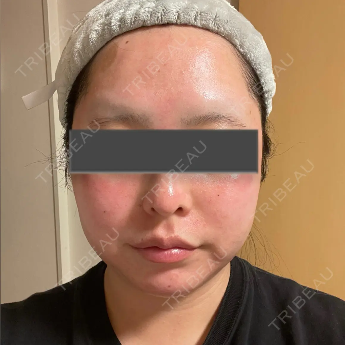 ヴェルヴェットスキン ブルームクリニック（BLOOM CLINIC） AFTER