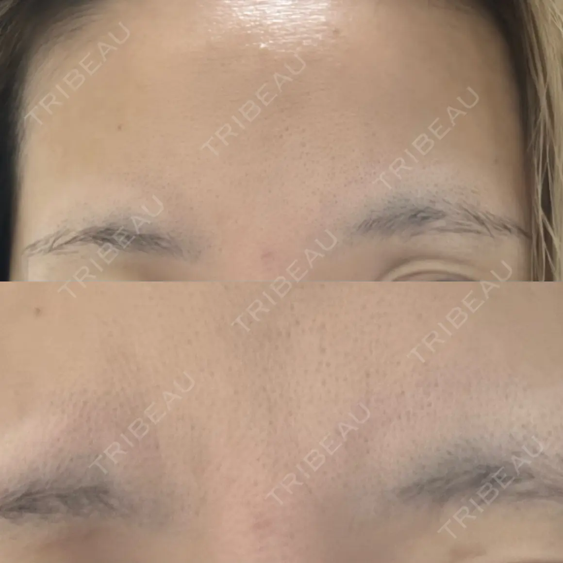 ボトックス（眉間） Leap beauty clinic AFTER