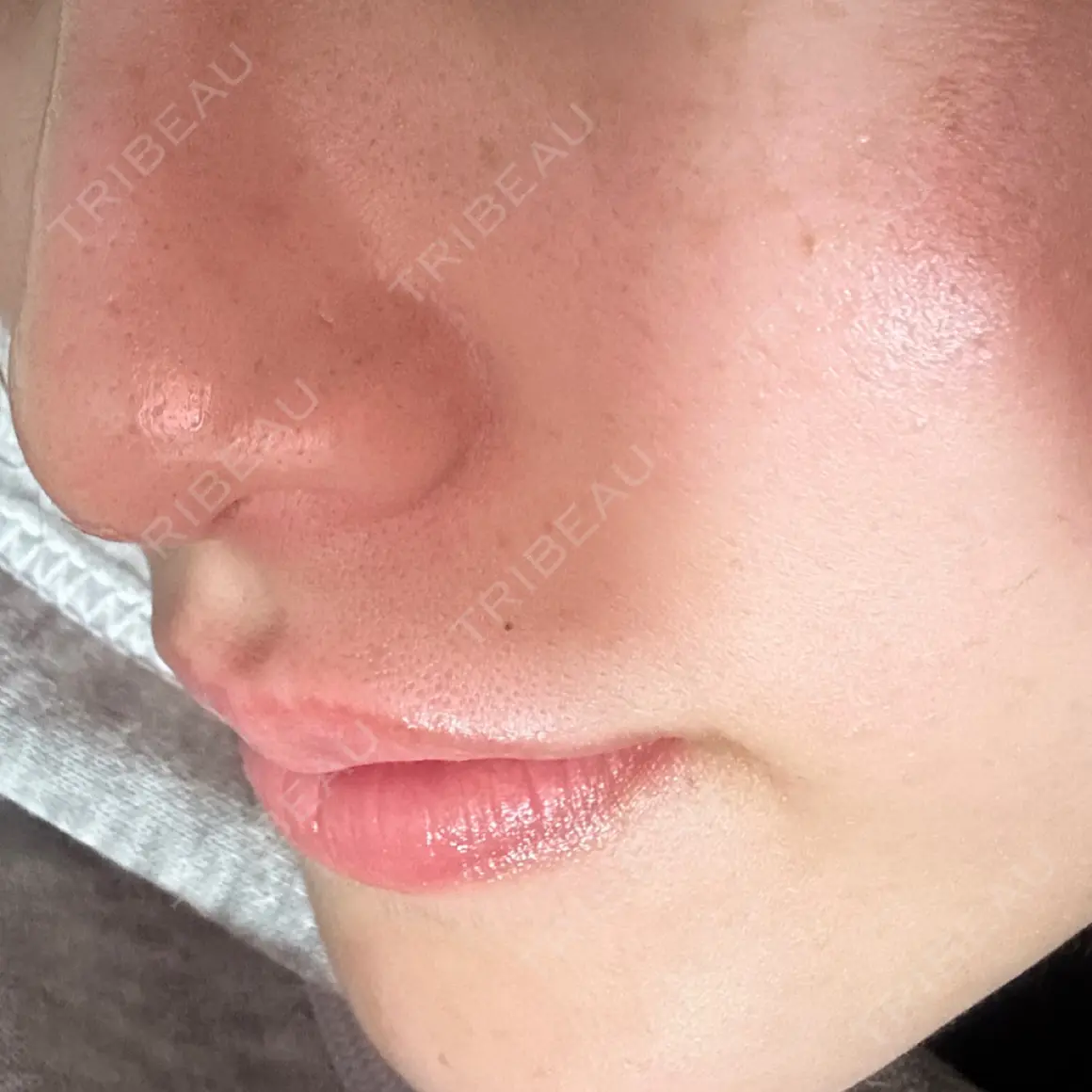 肌ヒアルロン酸注入（たるみ・シワ改善） Code Beauty Clinic 名古屋院 AFTER