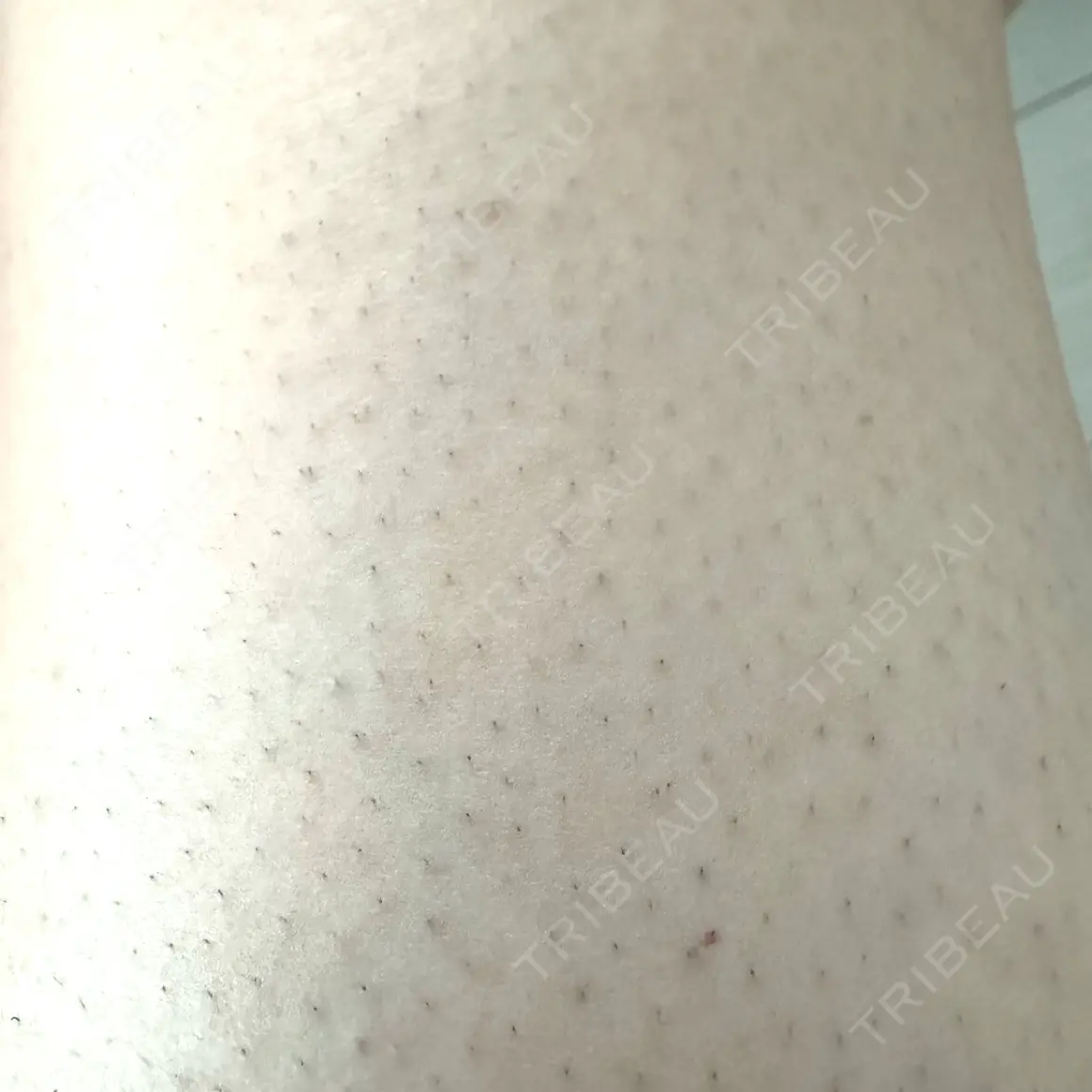 医療脱毛（全身） ブリリアスキンクリニック AFTER