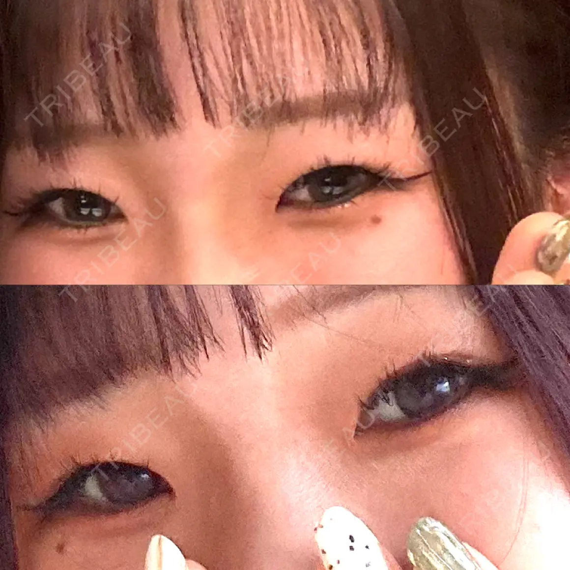 二重切開 サラ美容外科 AFTER