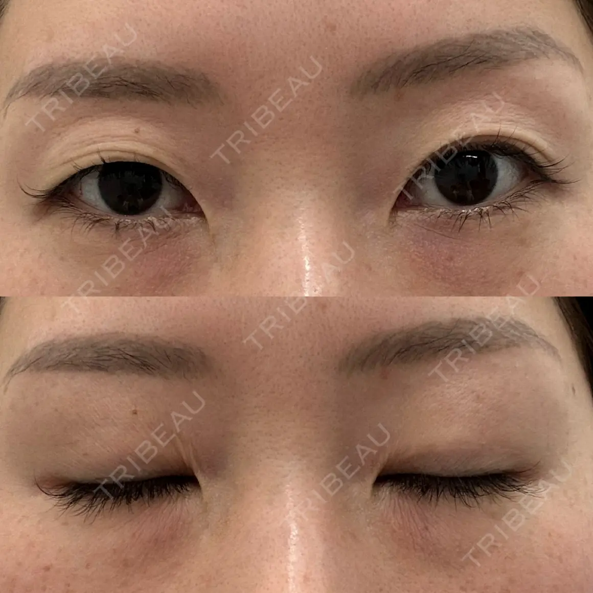 二重埋没 湘南美容クリニック 枚方院 AFTER