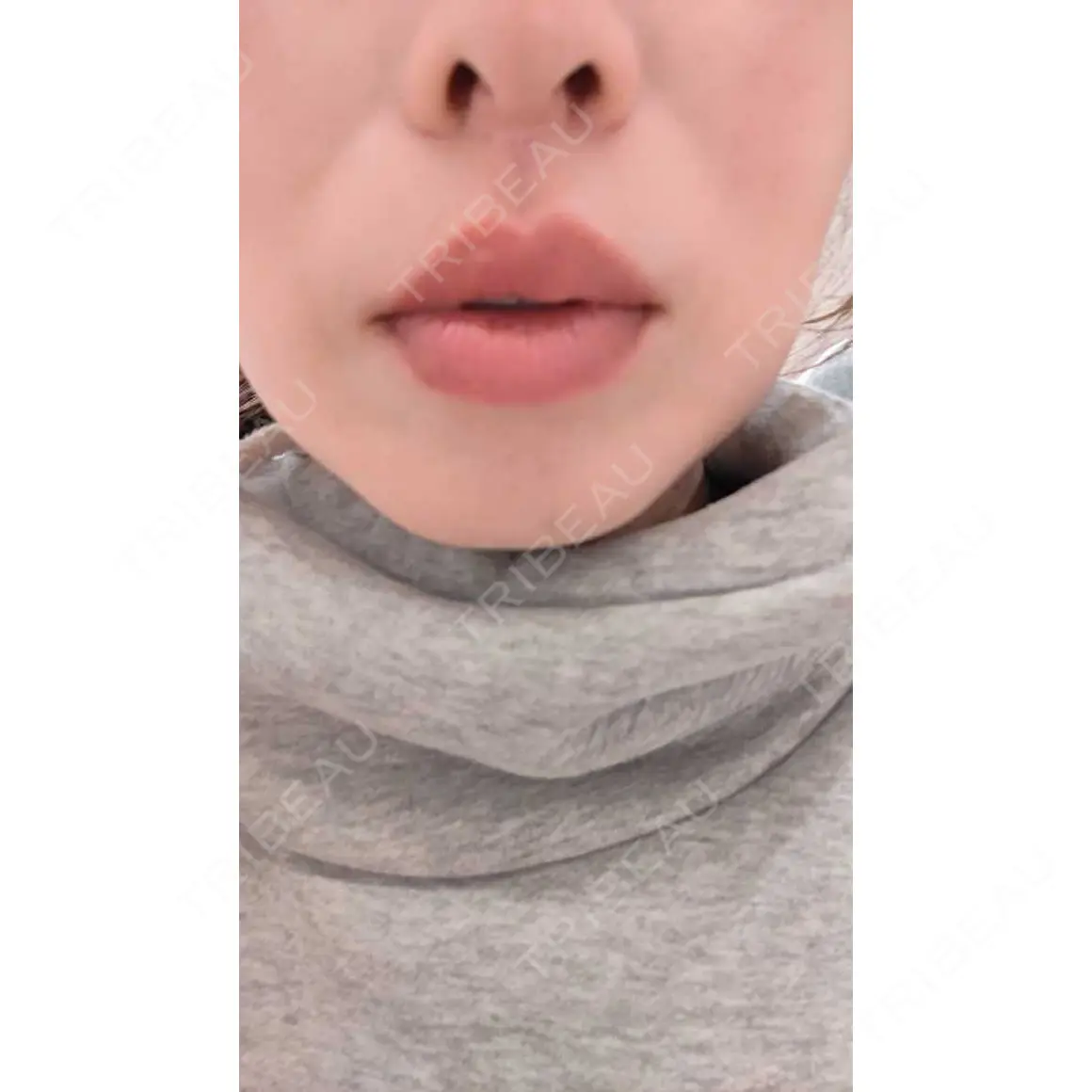 ヒアルロン酸注入（唇） AZ BEAUTY CLINIC AFTER